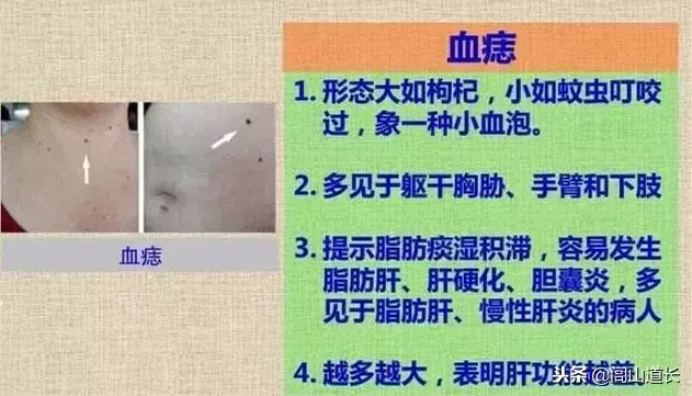 閭山道長：血痣，肝膽病變前兆！
