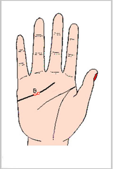 感情線上的「圈圈」稱「島紋」，注意，島紋是凶兆！