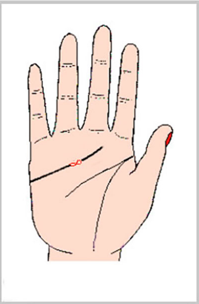 感情線上的「圈圈」稱「島紋」，注意，島紋是凶兆！