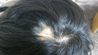 頭髮一塊一塊的禿是怎麼回事,為什麼頭髮會一塊一塊的掉