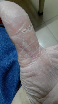 手指裂開口子如何處理,手指裂口子怎麼辦