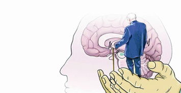 帕金森病是什麼病,帕金森是什麼病??