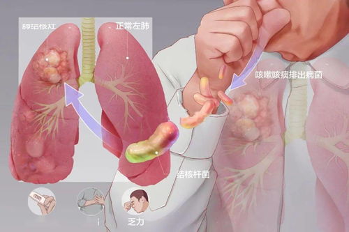 結核病是什麼病,結核病是什麼病