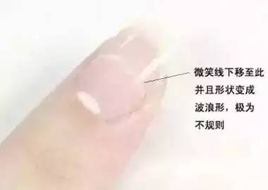 你的健康如何，看看你的手指頭就知道了